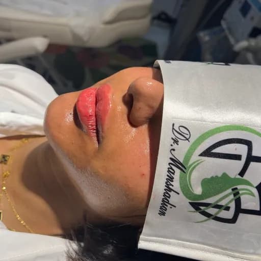 ژل لب و چانه