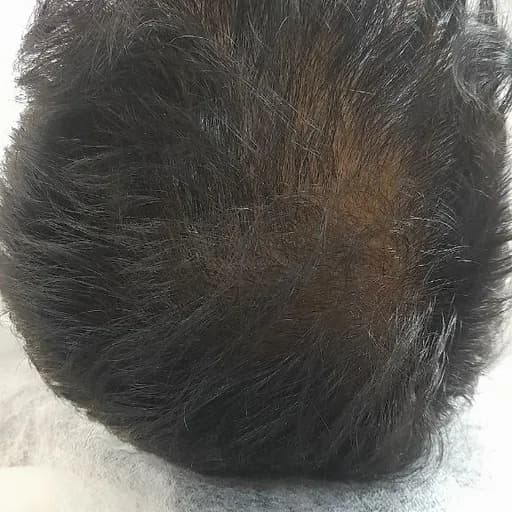 مزوتراپی سر